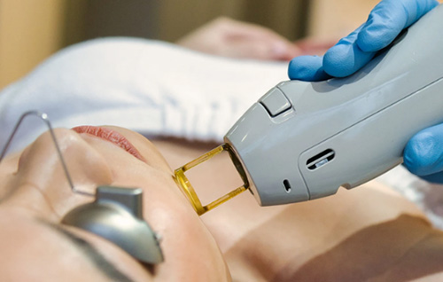 Dlaczego coraz więcej klientów wybiera laser Aleksandryt do usuwania włosów?