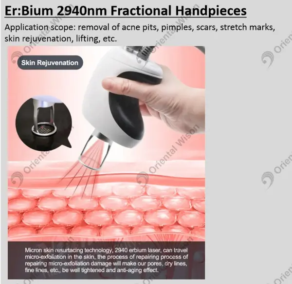 Nowy ekspert w dziedzinie odnowy skóry – laser erbowy o długości fali 2940 nm