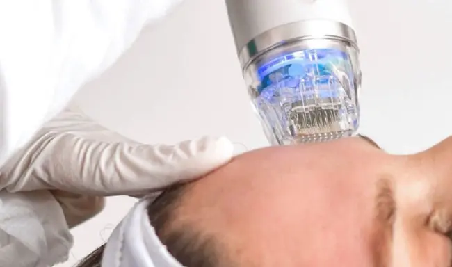 Jakie są zalety zabiegu mikroigłowego RF?