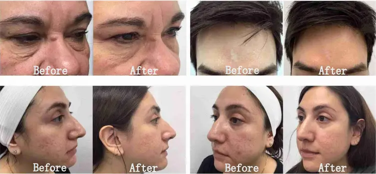 M8 Microneedle Rf Machine